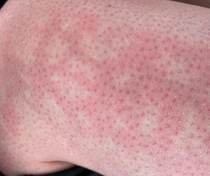 Heating Pad Rash: Causes, Treatment, and When to Get Help